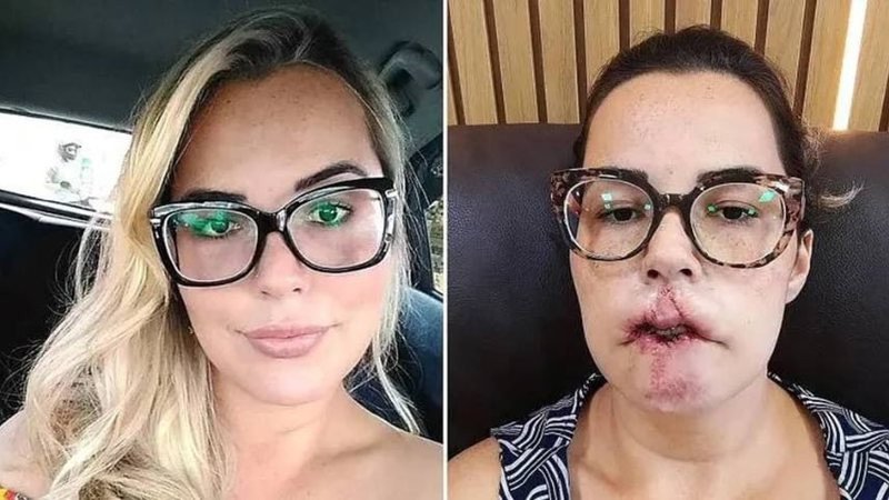 Mulher perde o lábio superior após realizar preenchimento com PMMA