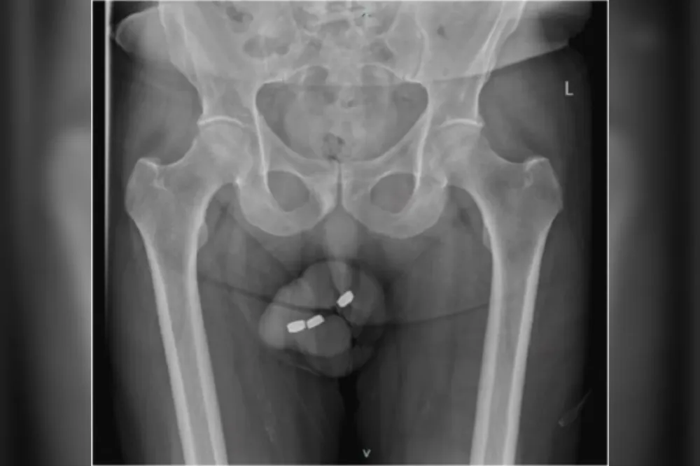 Idoso com impotência enfia 3 baterias no pênis e perde parte do órgão