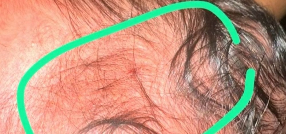 Recém-nascida é atingido de raspão por bala perdida dentro de hospital em Recife