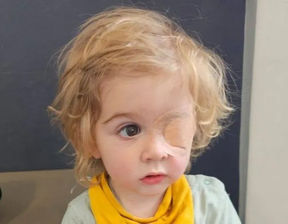 Criança perde a visão de um olho após ser beijado por pessoa com herpes labial