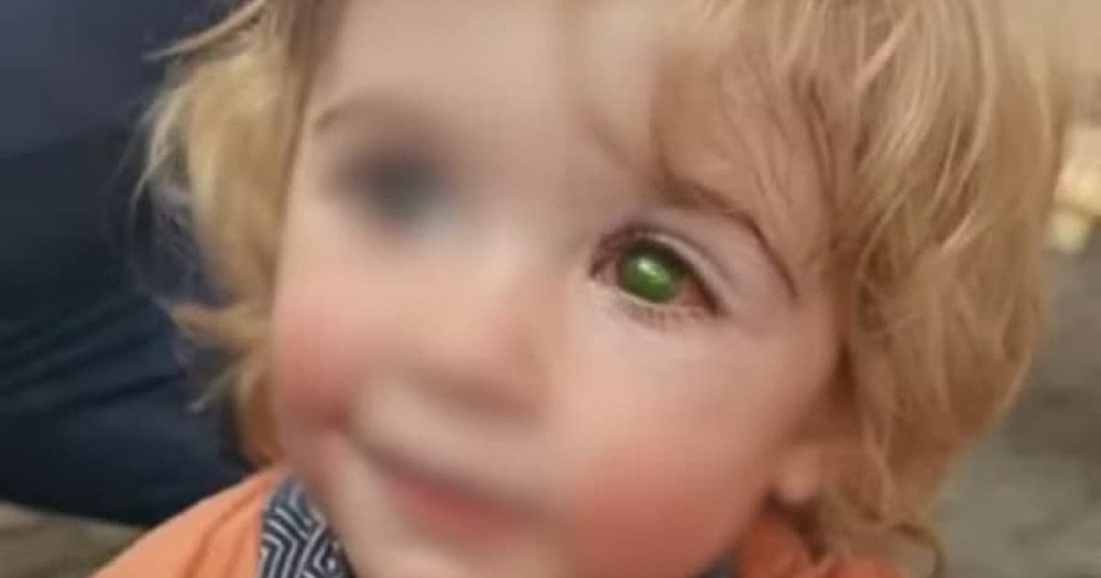 Criança de 2 anos perde visão de um olho após receber beijo de pessoa com herpes labial