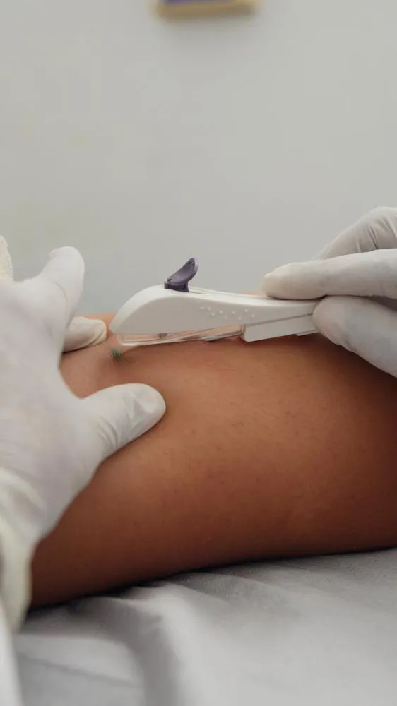 São Sebastião do Passé passa a oferecer Implanon pelo SUS
