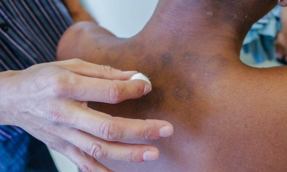 Crianças do Norte do país têm risco 34 vezes maior de contrair hanseníase do que as do Sul