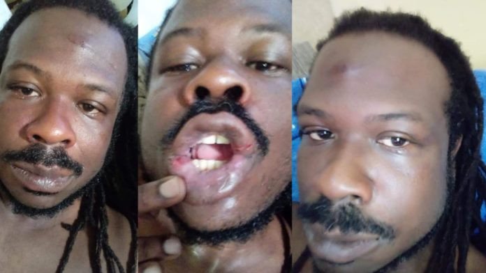 Assessor do deputado Jacó é espancado e vítima de racismo em bar no Rio Vermelho
