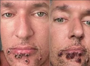 Infectado com Monkeypox, ator compartilha fotos de evolução das feridas
