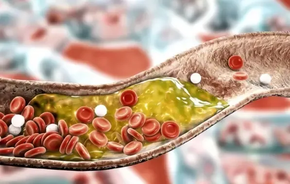 Anvisa aprova remédio para colesterol injetado apenas 2 vezes por ano